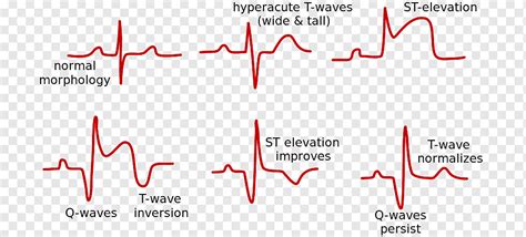 T Wave Elevation