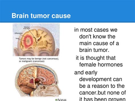 PPT - brain tumors PowerPoint Presentation, free download - ID:3923651