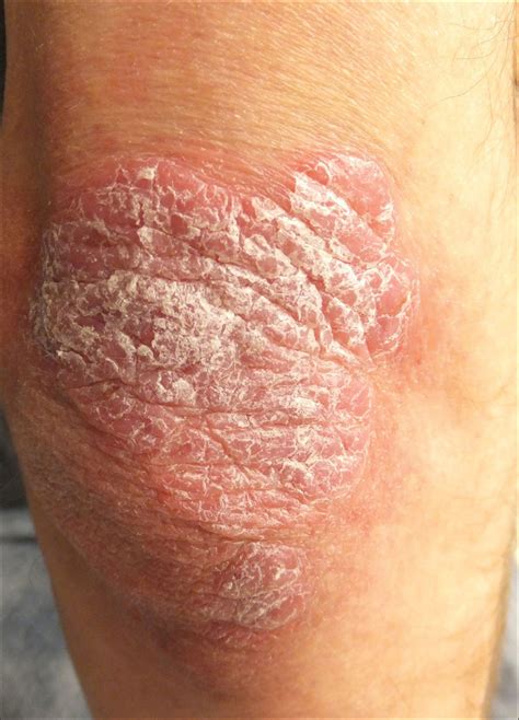 Thick Scaly Plaques on the Wrists, Knees, and Feet | MDedge Dermatology