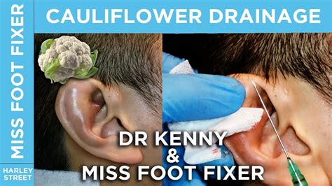 Dr Kenny & Miss Foot Fixer Cauliflower Ear Drainage | How to drain ear - YouTube