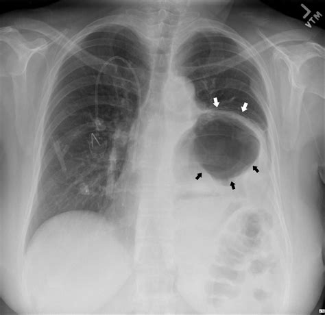 “A Large Hiatal Hernia”: Atypical Presentation of Gastric Volvulus - The Western Journal of ...