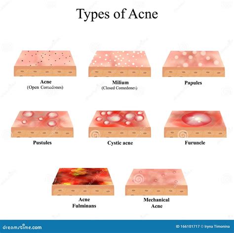 Types Of Acne Pimples Cartoon Vector | CartoonDealer.com #85138653