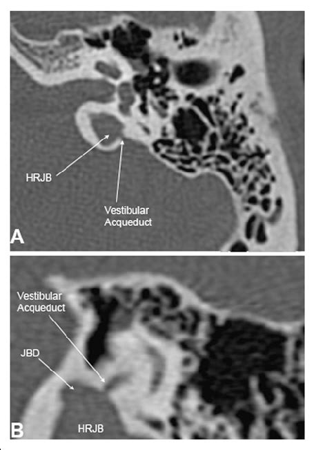 Patient 1: Left temporal computed tomography scan showing a high-riding ...