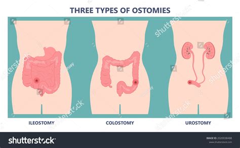 37 Ureterostomy Images, Stock Photos & Vectors | Shutterstock