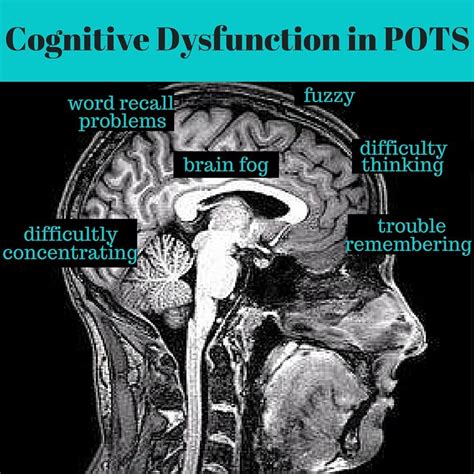 Cognitive Dysfunction and “Brain Fog” in POTS | The Dysautonomia ...