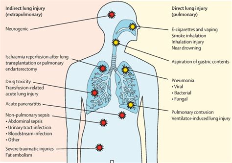 Acute respiratory distress syndrome: causes, pathophysiology, and ...