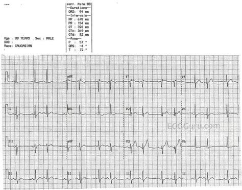 Atrial bigeminy | ECG Guru - Instructor Resources