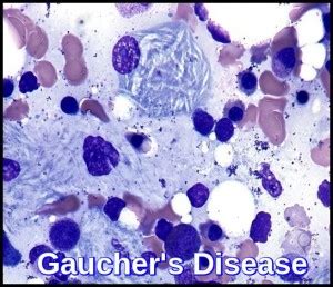 Gaucher's Disease - Ask Hematologist | Understand Hematology