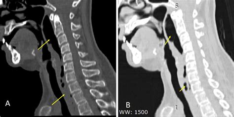 Retropharyngeal abscess – Radiology Cases