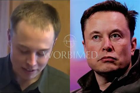 Elon Musk Hair Transplant l Before and After