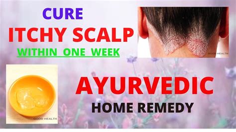 itchy scalp ? ||home remedy for itcy hair scalp||ayurvedic remedy ...