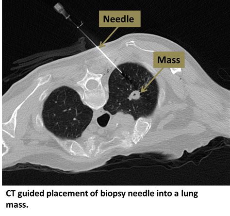 Lung Biopsy - Interventional Radiology | UCLA Health