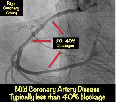 Heart Blockage: Explained with Pictures • MyHeart