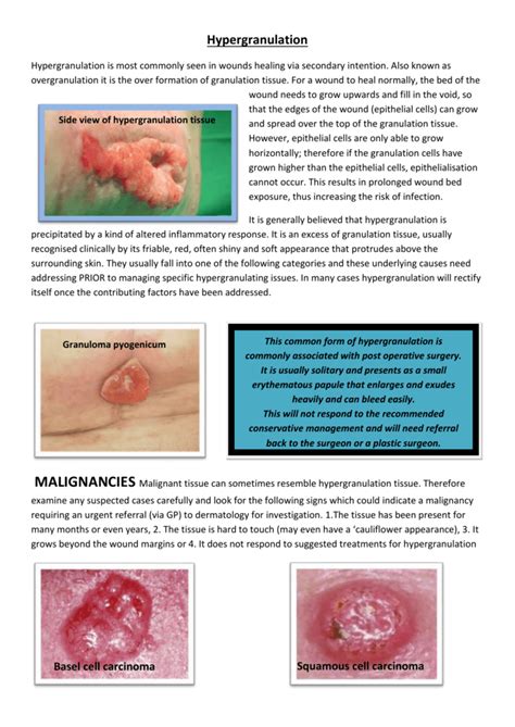 Local Guidelines Hypergranulation