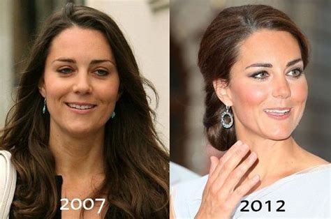 Kate Middleton Nose Job Before and After photo | Celebrity plastic surgery, Nose job, Plastic ...