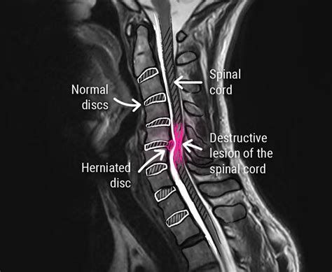 Cervical Disc Herniation - CCV Montpellier