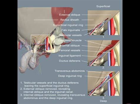 Laparoscopic Inguinal Hernia Surgery Anatomy