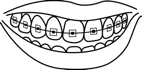 Dental braces Dentistry Human tooth Drawing - tooth cavity png download ...