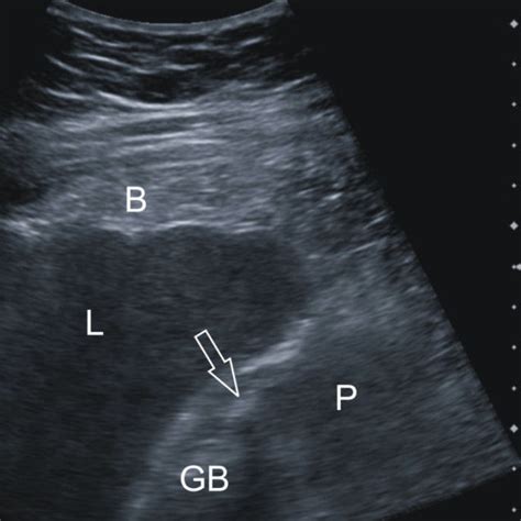 Sonography of the abdomen. This was performed after admission to our ...