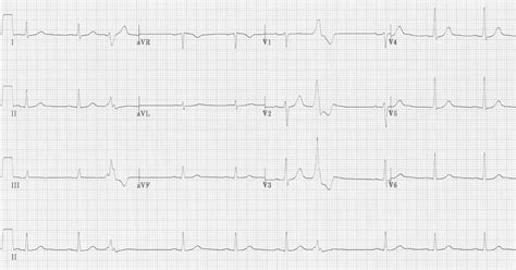 Premature Ventricular Complex (PVC) • LITFL • ECG Library Diagnosis