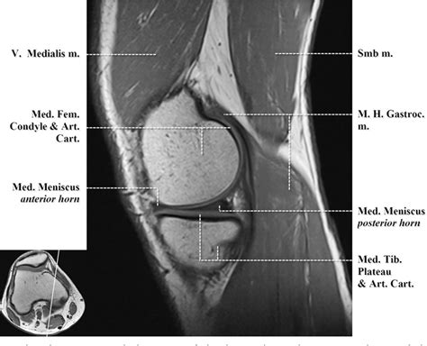 Figure 2 from Normal MR imaging anatomy of the knee. | Semantic Scholar