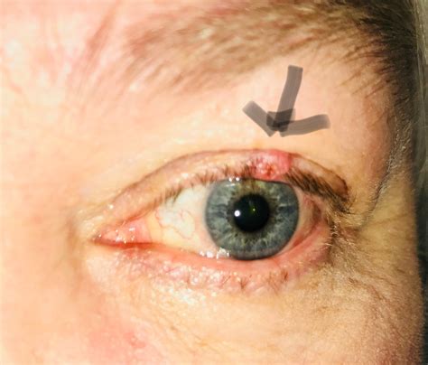 Eyelid Cancer Treatment in 2018