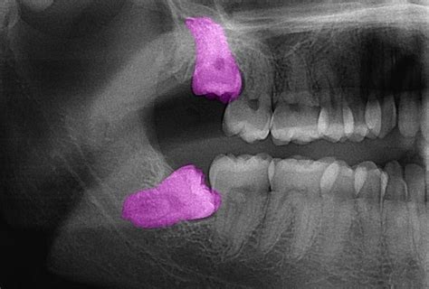 Impacted tooth (tooth impaction) | Studio Dentaire