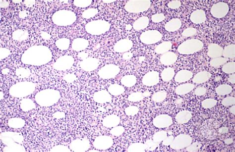 Subcutaneous Panniculitis-like T-cell Lymphoma - 3.