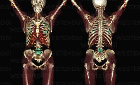 3D CT scan of metastatic bone cancer stock photo