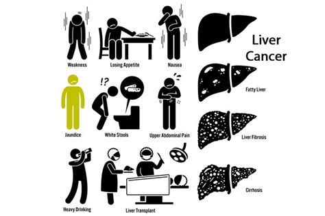 Liver Cancer 101: Symptoms, Causes, Stages & Treatment - Homage