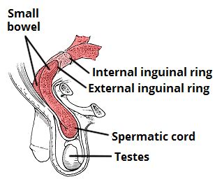 Direct And Indirect Inguinal Hernia