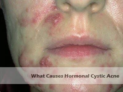 What Causes Hormonal Cystic Acne? 11 Cause You Must Aware | Hormonal Acne Tips