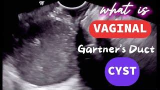 Vaginal - Gartner's Duct Cyst | Ultrasound | Doovi