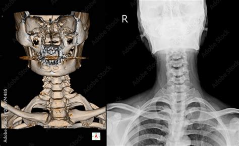 CT Scan cervical spine 3 D render and X-ray C-spine finding Reverse cervical lordosis Thoracic ...