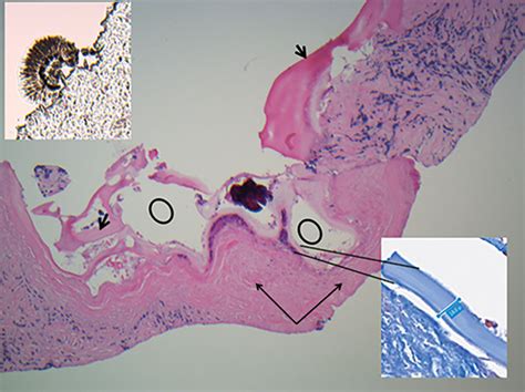 Figure 2 - Disseminated Echinococcus multilocularis Infection without ...