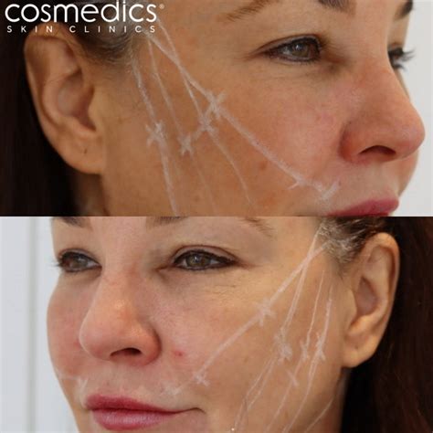 Thread Lift Facelift Treatments | Cosmedics Skin Clinics