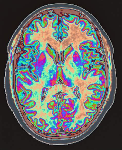 AI could spot Alzheimer’s in MRI scans up to a decade before symptoms ...