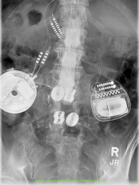 Intrathecal Pump | My Pain Web