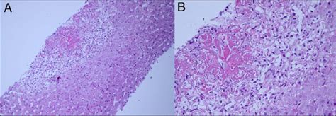 Liver biopsy of the hepatic lesion at right hepatic lobe revealed... | Download Scientific Diagram