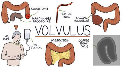 Sigmoid Colon Volvulus