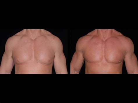 Gynecomastia Before and After | Premier Plastic Surgery