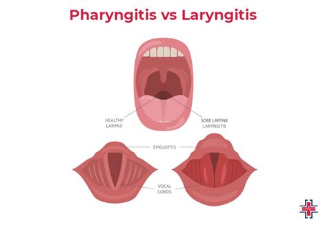 Pharyngitis: A Comprehensive Guide to Symptoms, Causes, Prevention and Treatment | ER of Mesquite