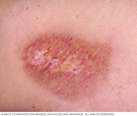 Burns Disease Reference Guide - Drugs.com