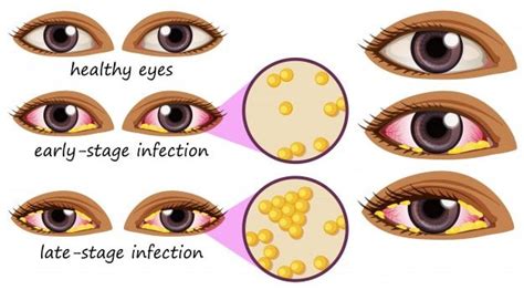 Pink Eye Treatment Online from Expert Doctors in California