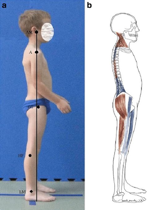 Flat-back posture in a 9-year-old boy. a Habitual standing, lateral... | Download Scientific Diagram