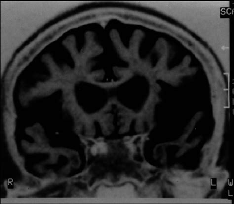 MRI coronal image showing bilateral frontal and temporal lobes atrophy ...