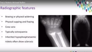 Pathophysiology and Clinical Features of Rickets ...