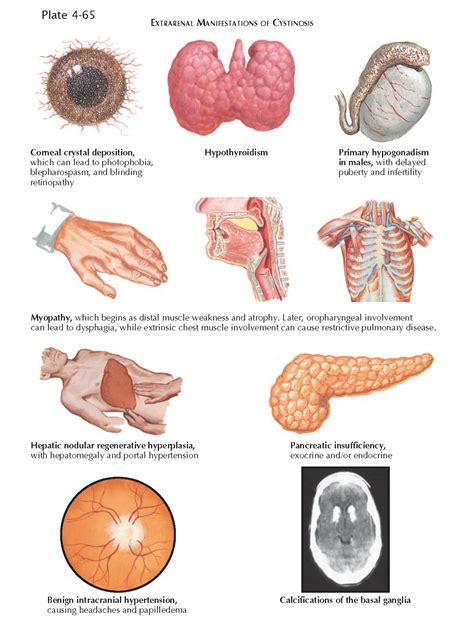 CYSTINOSIS - pediagenosis