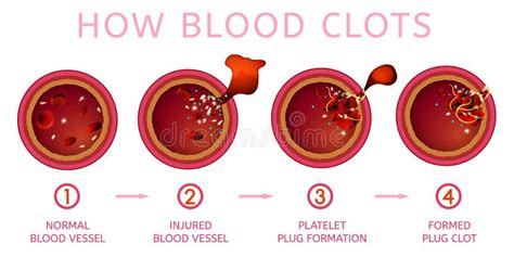 Coagulazione Del Sangue Fase 4 Infographics Illustrazione Di Vettore Illustrazione di Stock ...