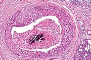 Salivary duct carcinoma - Libre Pathology